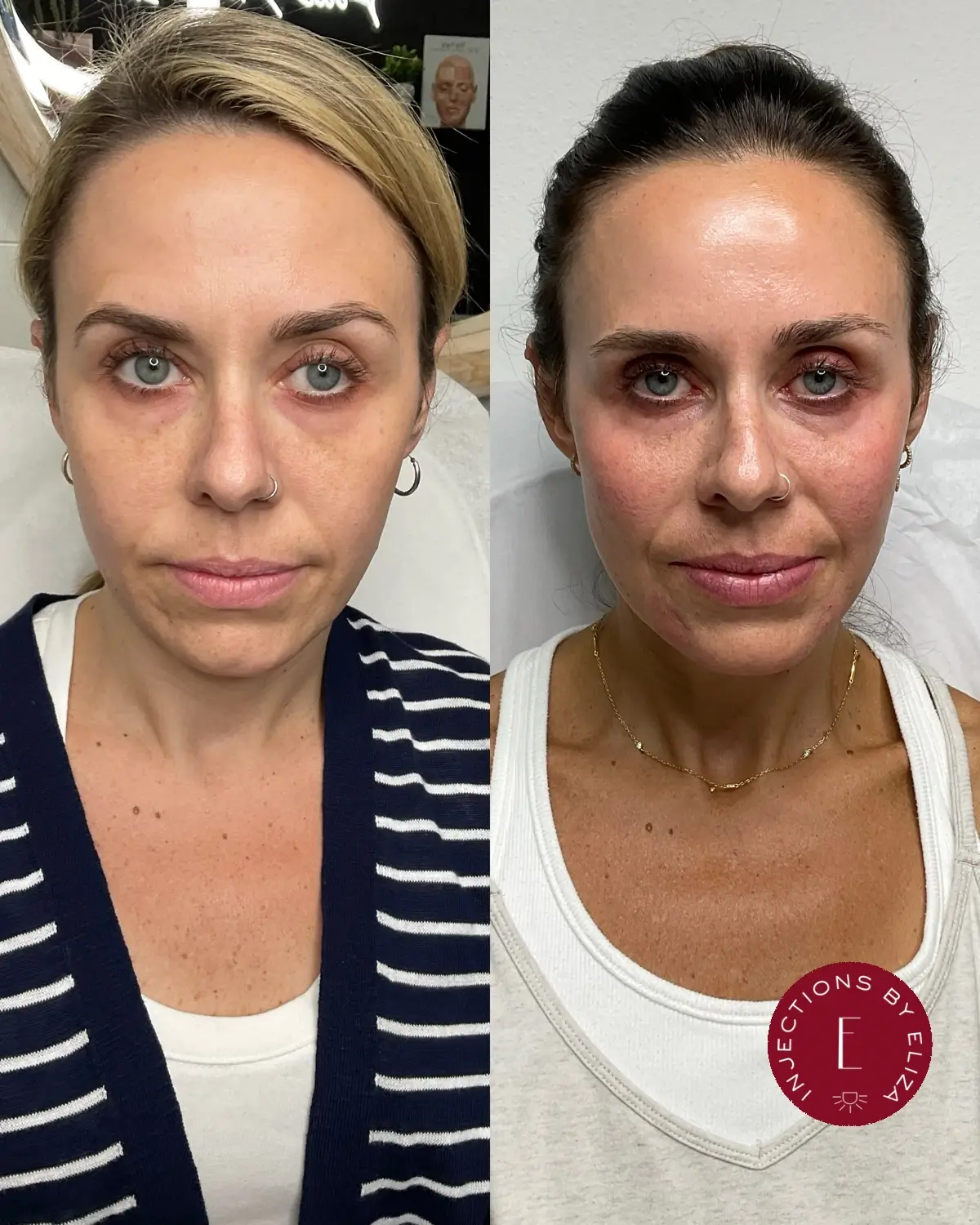 Facial harmonization, 1
