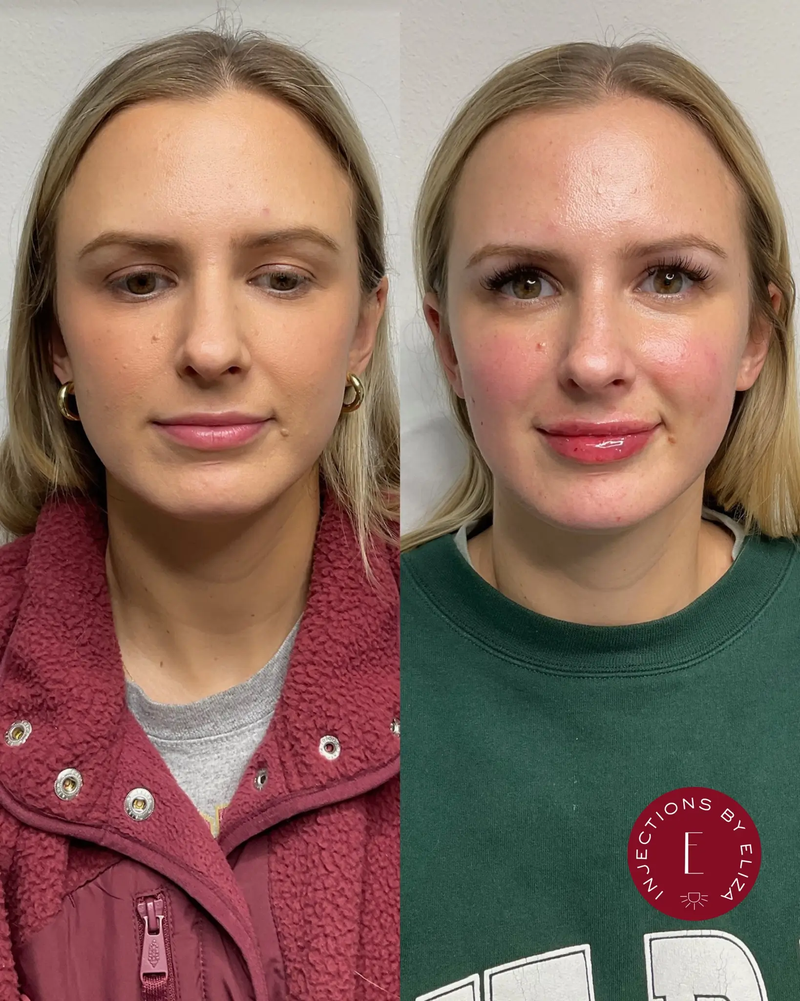 Full face dysport 1