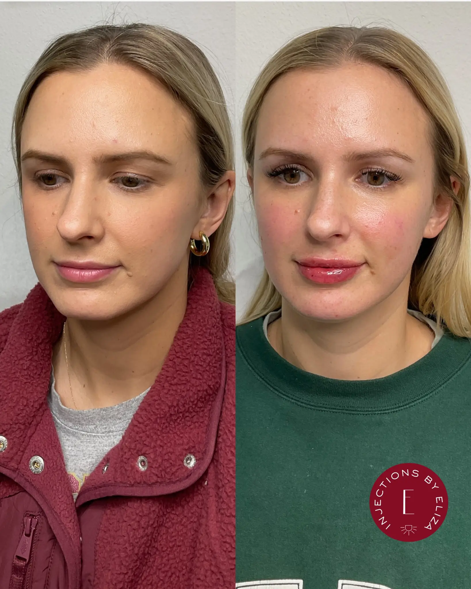 Full face dysport 2