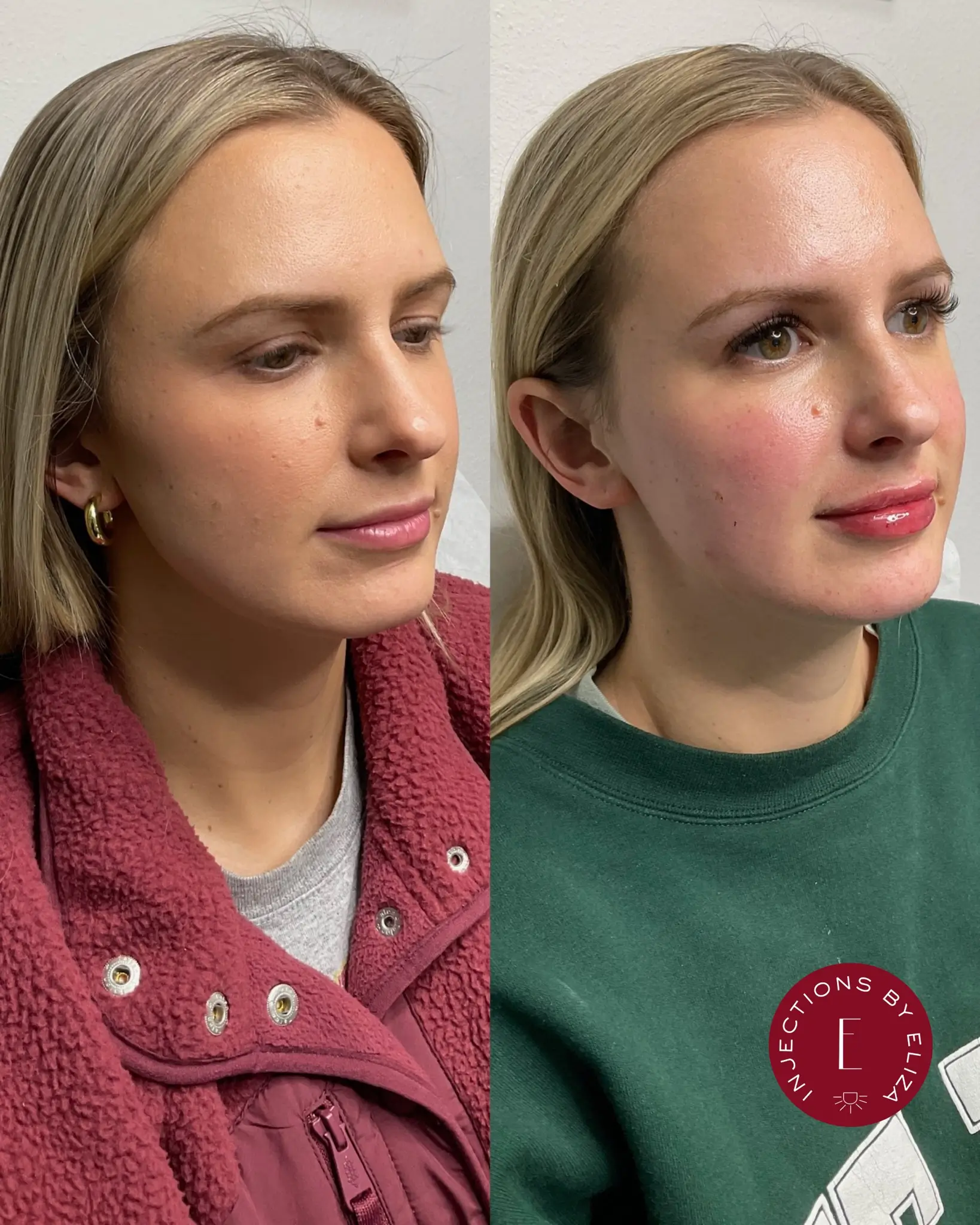 Full face dysport 3